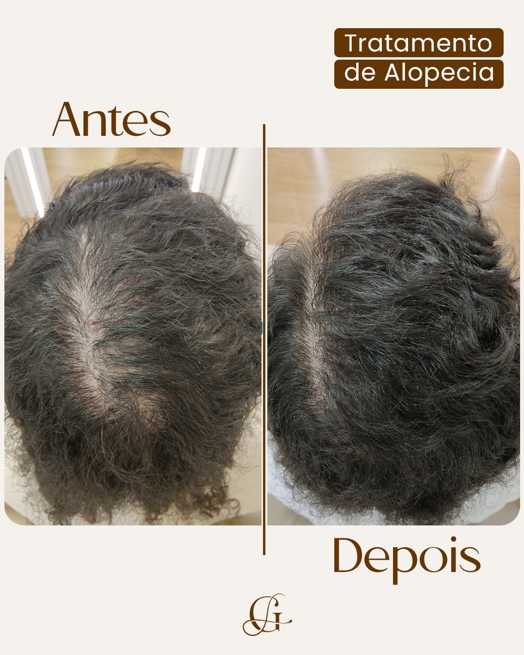 Antes e depois de tratamento de calvície com tricologia clínica
