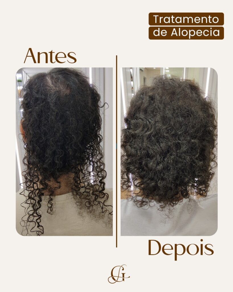 Antes e depois de tratamento de alopecia em cabelo cacheado